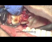 Learning Minor Oral Surgery