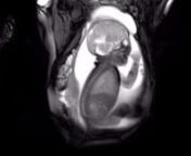An MRI scan shows an unborn baby at 36 weeks. You can see him sucking his thumb.nnsee webapp:nhttps://web.bestbeginnings.org.uk/web/video/mri-scan-at-36-weeks-11391/videos