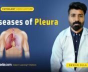 Get knowledgeable about Diseases of Pleura in this V-Learning™ lecture. These diseases include pneumothorax, pleural effusion, and pleuritis. In addition to this, detailed explanation is provided on tumors of pleura which are categorized as localized fibrous tumors and malignant mesothelioma.nn-------------------------------------------------------------nWatch complete lecture on sqadia.com:nhttps://www.sqadia.com/programs/diseases-of-pleurannLecture Duration: 00:43:04nReleased: September 2019