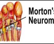 Morton’s Neuroma - Podiatrist in Pinellas County and Oldsmar, FL - Allan Rothschild, DPMnnDr. Allan Rothschild Foot and Ankle Specialist discusses the symptoms, causes and treatments for Morton’s neuroma.n http://www.mainstreetfeet.com n Neuromas are enlarged benign growths of nerves, most commonly between the third and fourth toes. They are caused by tissue rubbing against and irritating the nerves. Pressure from poorly-fitting shoes or abnormal bone structure can create the condition as we