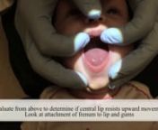 Proper technique is necessary determining whether or not a baby has a tongue-tie or lip-tie that could impact breastfeeding. This video shows you how to do that.