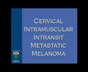 DR. ARIYAN, DR. CLUNE - Cervical Intramuscular Intransit Metastatic Melanoma - 5 minutes - 2014 from ariyan