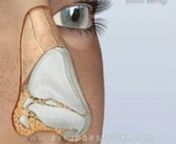 Burun estetiği, estetik burun ameliyatı açık rinoplasti tekniği video görüntüleri izle, ünlü estetik cerrah Op. Dr. Nazmi Bayçınnhttp://www.xn--burunestetii-nyb.com.tr