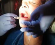 Around the mouth region is a sensitive area with extensive sensory innervations from multiple nerves; around the mouth, nerve block should be strongly considered for best comfort. The application of ice before and after the procedure and massage. Selection of the smallest suitable needle, slow infiltration, and minimizing the number of needle punctures can also improve patient comfort. Successful lip augmentation is highly dependent on the choice of filler material, w If the surgeon is trying to