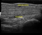 Musculoskeletal Ultrasound - Hand - Palmar fibromatosis from fibromatosis hand