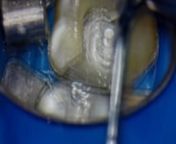 Placement of a bonded amalgam core with gingivectomy.