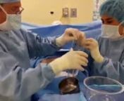 Watch as Dr. DeLange performs a Breast Augmentation with the Keller Funnel to place a 625cc implant through the areola
