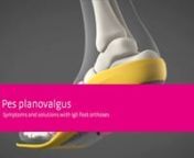 Foot malpositions like Pes planovalgus can affect the whole body. This video shows what happens in our feet when one is diagnosed with Pes planovalgus. You will also learn how igli foot orthoses can support our feet.