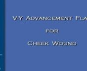 Dr Stephan Ariyan - V-Y ADVANCEMENT FLAP FOR CHEEK WOUND- 20min- 2009 from ariyan