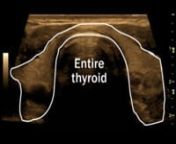 Normal Thyroid GlandnThis video clip represents a normal thyroid gland. The ultrasound starts with the right thyroid lobe. The right lobe is scanned to show the upper, mid and lower right pole. The right neck is then scanned to show the right carotid artery and the jugular vein. These are shown as dark circles to the left of the right lobe. The ultrasound then scans the left thyroid lobe showing the upper, mid and lower left poles. The left neck is then scanned showing the left carotid artery an