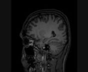 Scan of a brain using Magnetic Resonance Imaging about 120 sagittal slices, put together in a movie.nnEnjoy!